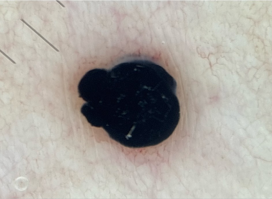 Image dermatoscopique d'une lésion cutanée pigmentée en gros plan, réalisée à la Pharmacie du Pont Neuf