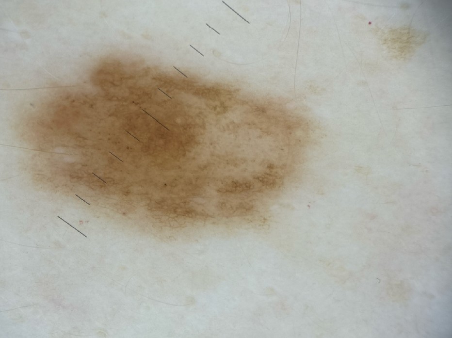 Image dermatoscopique d'un grain de beauté réalisée à la Pharmacie du Pont Neuf