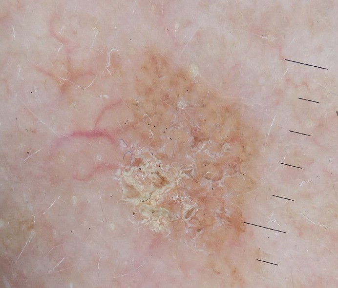 Image dermatoscopique d'une lésion cutanée réalisée à la Pharmacie du Pont Neuf