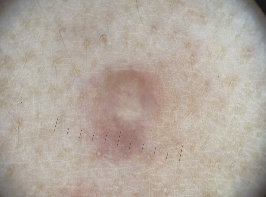 Image dermatoscopique d'une tache cutanée réalisée à la Pharmacie du Pont Neuf